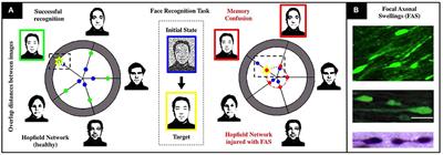 Estimating Memory Deterioration Rates Following Neurodegeneration and Traumatic Brain Injuries in a Hopfield Network Model